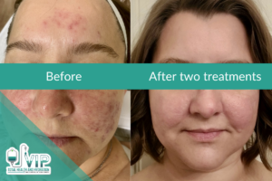 Microneedling for acne scar treatment in Fort Worth