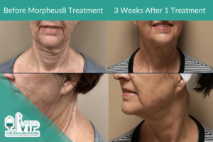 Non-invasive Morpheus8 Treatments Continue to Rise in Popularity