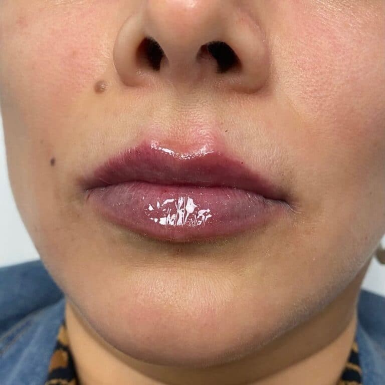 Fillers in Fort Worth