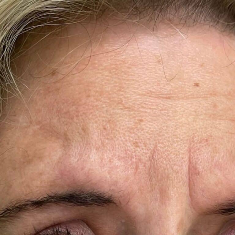 Botox 3 before