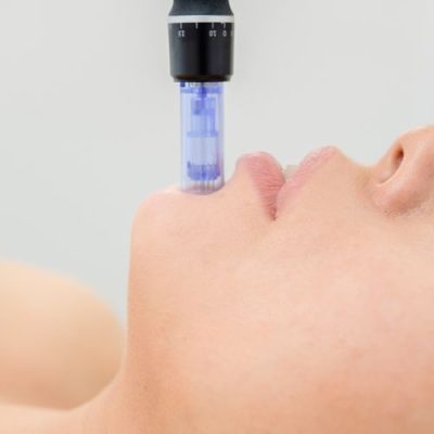 Microneedling Microneedling