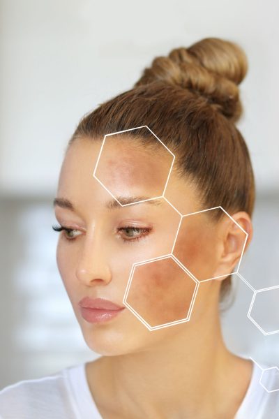 Skin Conditions Rosacea treatment at VIP Total Health and Hydration